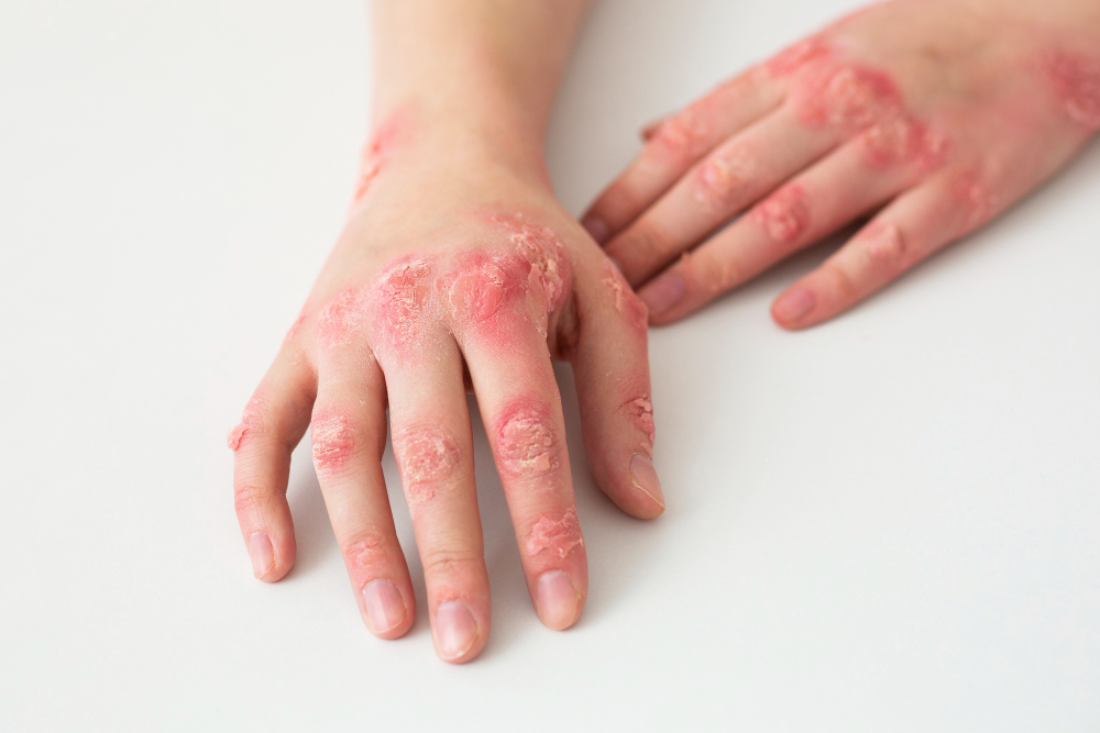 Atopik Dermatitte Eksozomlar